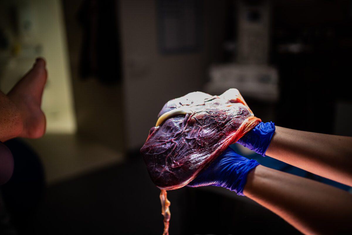 vrouw houdt placenta vast in ziekenhuis